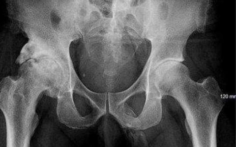 男子摔一跤竟查出生殖器骨化