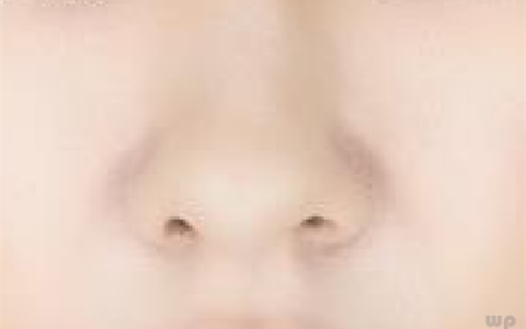 鼻子上挤出来白色条状, 是粉刺还是螨虫?